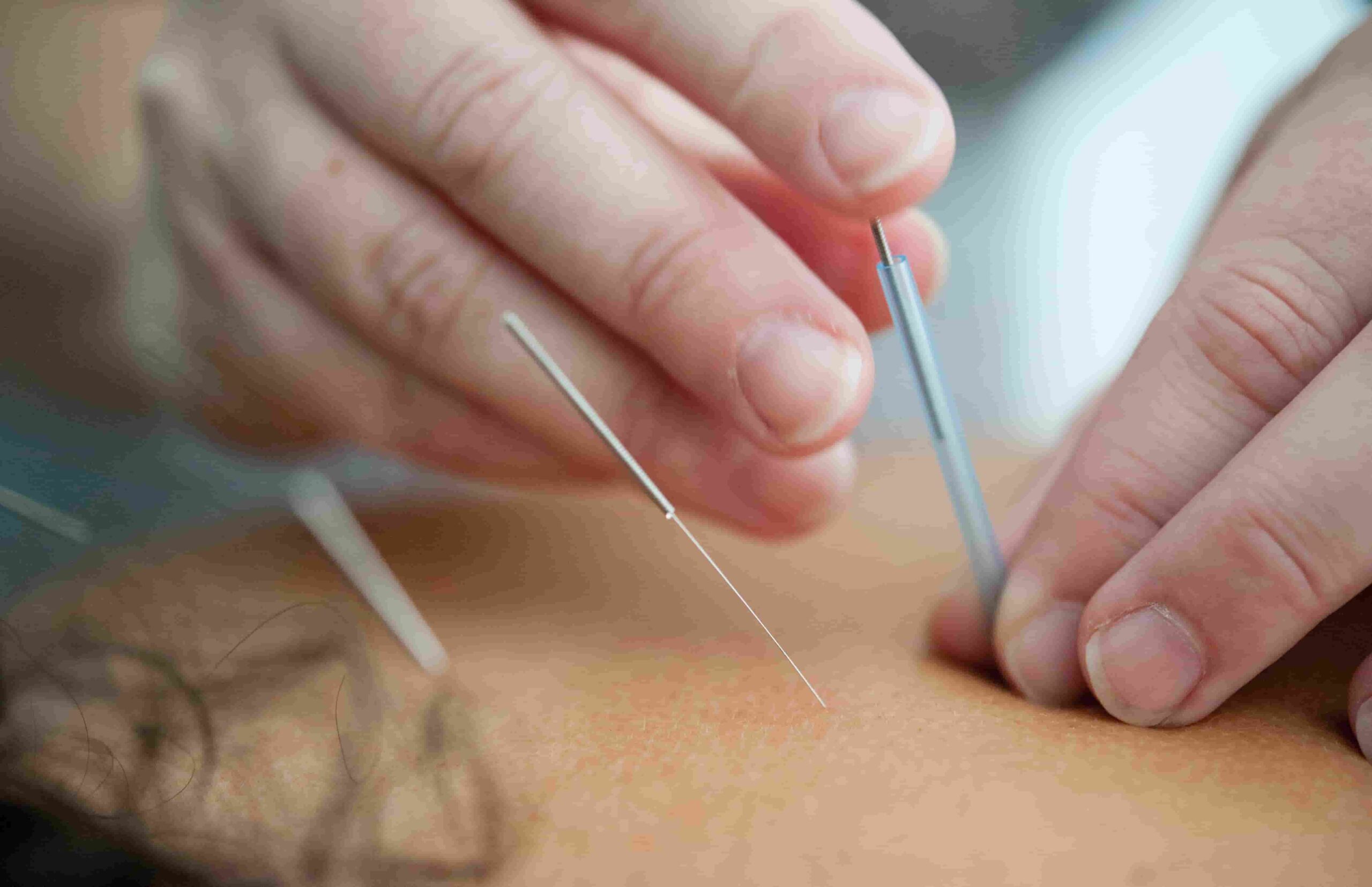Close-up of a practitioner's hands inserting a thin acupuncture needle into a patient's forearm; other needles visible nearby